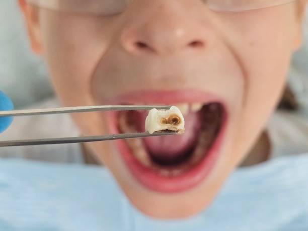 Best Emergency Gum Treatment in Sausalito, CA